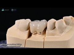 Màu răng tự nhiên Ceramic Feldspathic Veneer cho răng trước và sau