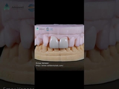 EMAX Veneer được ép tự nhiên Độ bền 16 sắc thái Emax Veneer răng