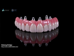 Hybrid Pink Porcelain Implant Crown Malong Full Arch Implant Bridge Tải ngay lập tức