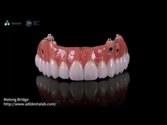 Composite Pink Porcelain Crown A1 Shade All On 4 Hybrid Titanium Screw được giữ lại