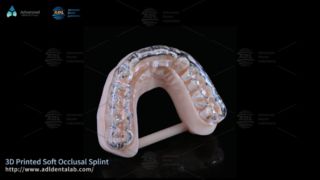Nẹp in 3D tùy chỉnh giúp bé dễ chịu khi nghiến răng