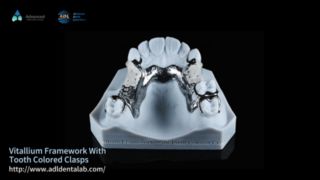 Vitallium Framework Thẩm mỹ tự nhiên Easy Fit