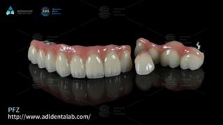 Mão răng PFZ Độ bền tự nhiên và độ vừa vặn chính xác