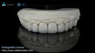 Mặt dán sứ Feldspathic có độ trong suốt cao cho nụ cười