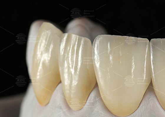 Mua 0.3mm-0.7mm Feldspathic EMAX Ceramic Veneers Vỏ răng Emax thẩm mỹ tự nhiên sản xuất trực tuyến