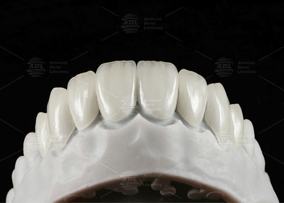 Mua EMAX Veneer được ép tự nhiên Độ bền 16 sắc thái Emax Veneer răng sản xuất trực tuyến