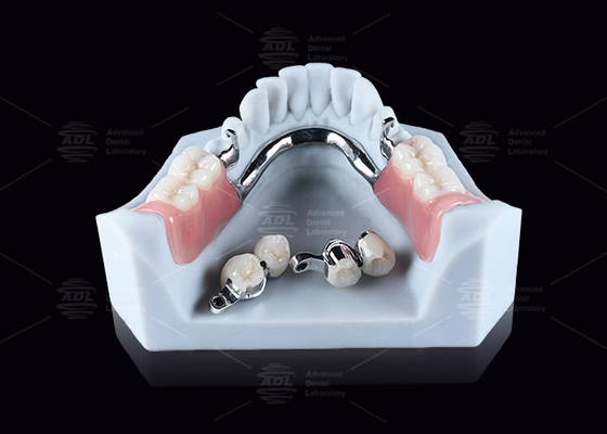 Mua CEKA M2 Tích hợp chính xác Titanium với khoảng cách ngang / dọc 3mm sản xuất trực tuyến
