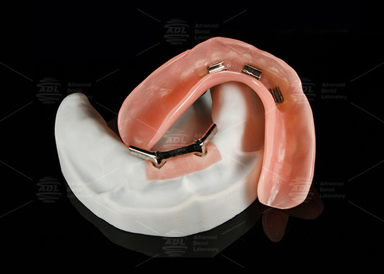 Mua Titanium hợp kim Snap On Dolder Implant Bar Overdenture được đánh bóng cho nụ cười tự nhiên sản xuất trực tuyến