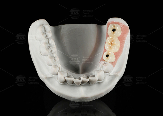 Mua Vít giữ Titanium Custom Abutment Porcelain hợp nhất với Zirconia sản xuất trực tuyến