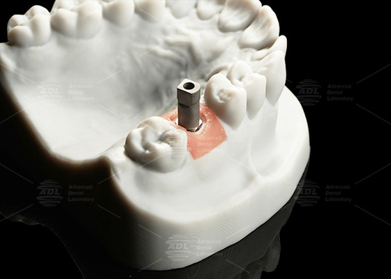 Mua Độ chính xác Titanium Digital Implant Scan Body Sandblasted Surface For Cad/Cam sản xuất trực tuyến