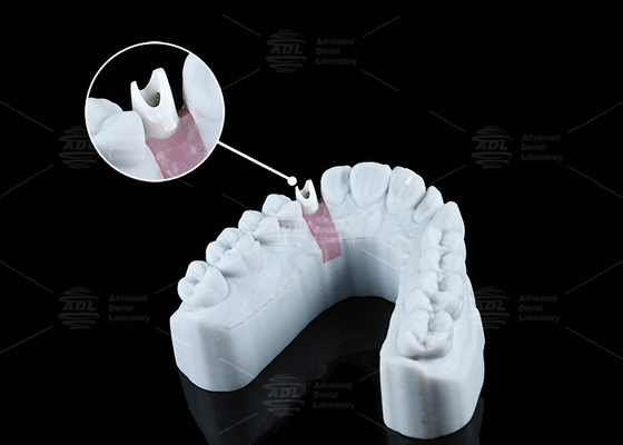 Mua Đen Custom Zirconia Abutment nhìn tự nhiên thẩm mỹ và chức năng tối ưu sản xuất trực tuyến