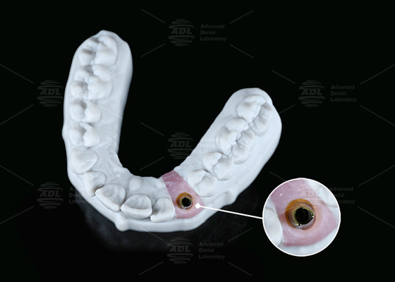 Mua Nội bộ Hex Custom Titanium Abutment Screw Cement giữ hình dạng khác nhau sản xuất trực tuyến