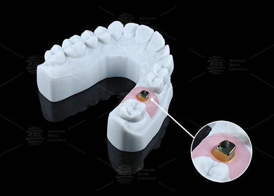 Mua Đồ cấy ghép và giải pháp nha khoa chống ăn mòn dựa trên titan tùy chỉnh sản xuất trực tuyến