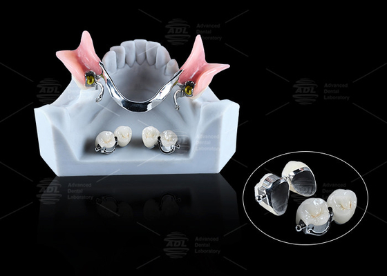 Mua CE FDA Ống đính hợp bóng răng giả thoải mái Ống đính hợp bóng răng giả lâu dài sản xuất trực tuyến