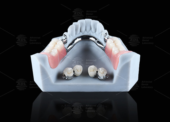 Mua Titanium răng cấy ghép quả bóng đính kèm thoải mái an toàn giữ răng giả sản xuất trực tuyến