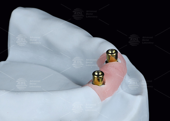 Mua Chọn vị trí răng giả Titanium Bracket Chọn vị trí răng giả sản xuất trực tuyến