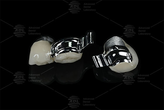 Mua Trung Quốc phòng thí nghiệm nha khoa điều chỉnh bệnh nhân cụ thể Keyway chính xác gắn với PFM sản xuất trực tuyến