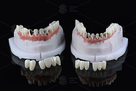 Mua Trung Quốc Phòng thí nghiệm nha khoa Titanium Full Arch Hybrid Bridge với tải ngay lập tức A1 Shade Malong Design Screw Retained Cad / Cam sản xuất trực tuyến