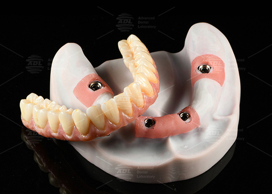 Composite Pink Porcelain Crown A1 Shade All On 4 Hybrid Titanium Screw được giữ lại