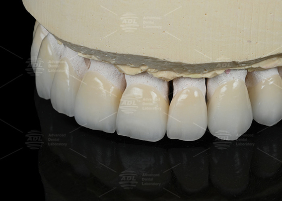 Màu răng tự nhiên Ceramic Feldspathic Veneer cho răng trước và sau