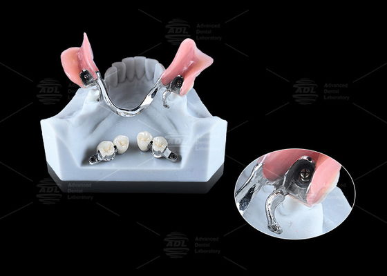 0.1mm Độ khoan dung CEKA REVAX Thiết bị đính kèm Titanium 3mm Độ trống dọc