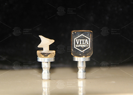 Phục hồi răng đơn Enamic Ceramic Vita lai với độ mờ cao