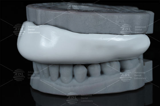 Thích hợp Occlusal Splint Sport Guard Bite Splint Thiết kế dễ dàng để làm sạch Thiết bị bảo vệ thoải mái cho nghiền răng