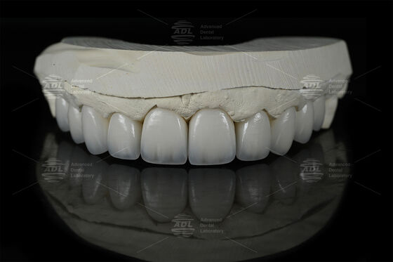 0.3mm-0.7mm Feldspathic EMAX Ceramic Veneers Vỏ răng Emax thẩm mỹ tự nhiên